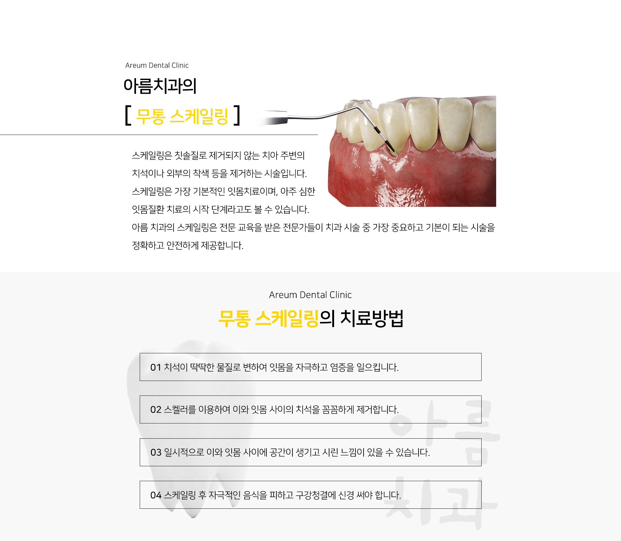 무통 스케일링