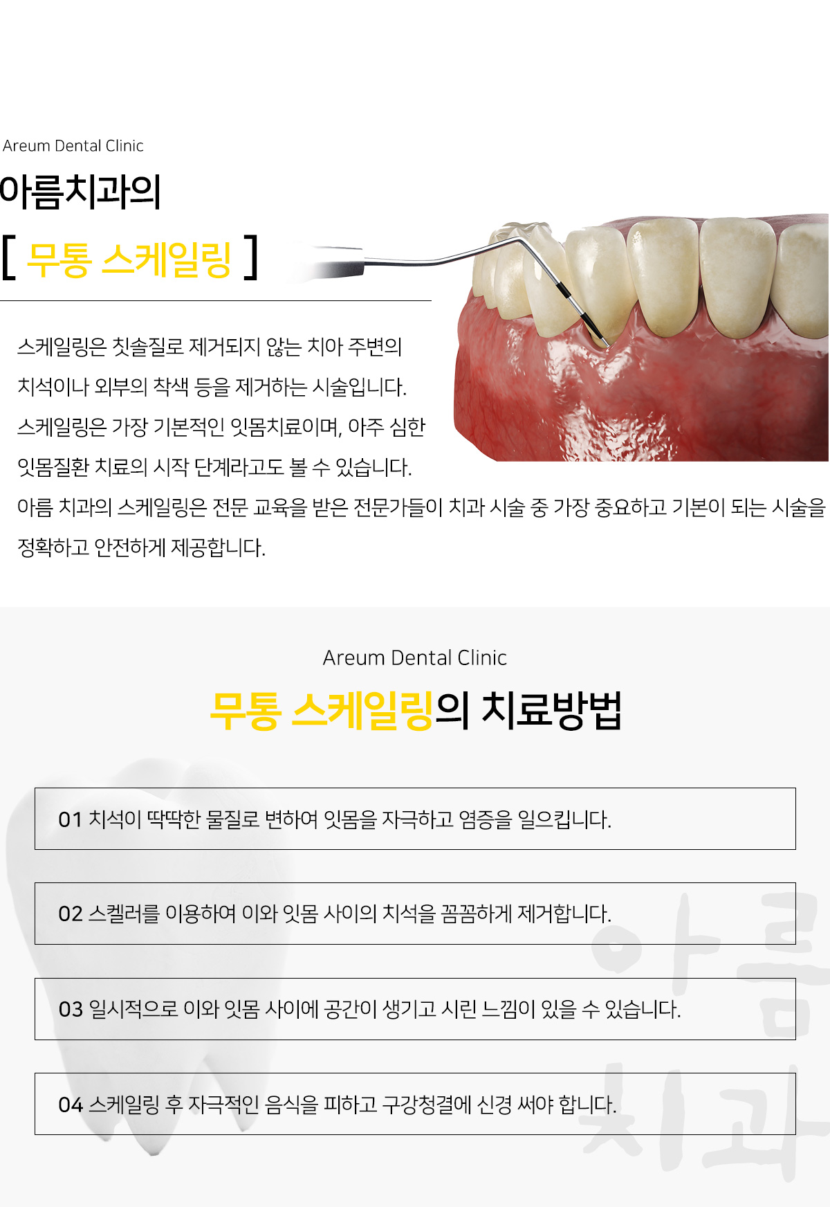 무통 스케일링