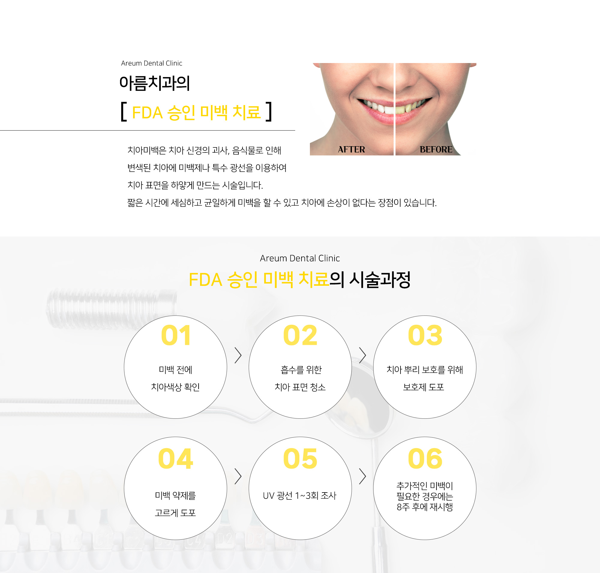 FDA 승인 미백 치료